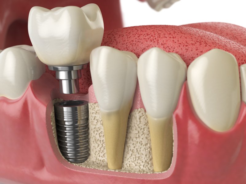 Dental Implant – Is It Worth Your Money? - Tom Kalili